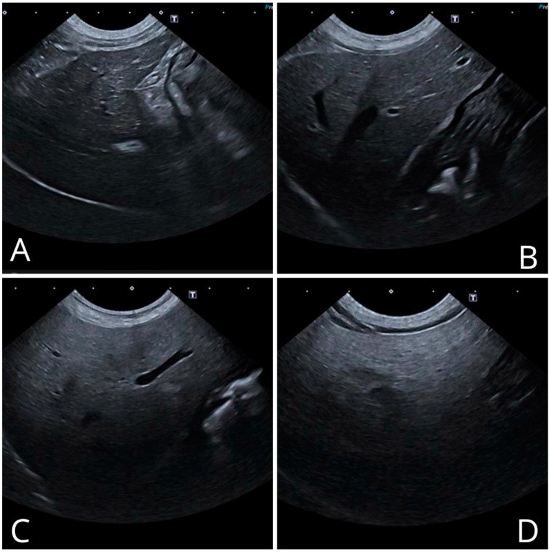 Full source JPEG: ultrasound liver figure